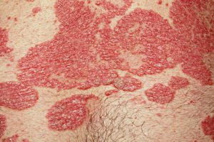 Dandruff VS psoriasis