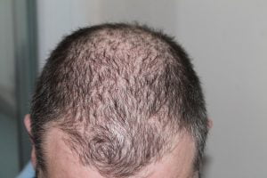 Dandruff and hair loss