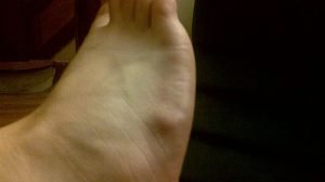 Ganglion Cyst on Foot