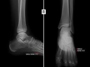 Bone cyst on foot