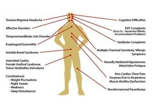 Regional symptoms and syndrome related to fibromyalgia