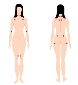 Fibromyalgia Pain Points (Trigger Points)