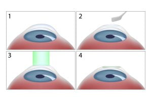 Photorefractive Keratectomy (PRK)