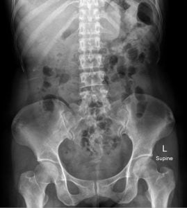 X-ray image of Kidney and Urinary system