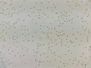 Blood in urien due to UTI