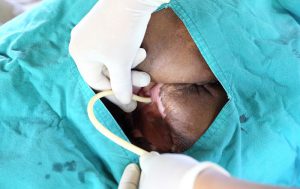Catheter-related urinary tract infection (UTI)