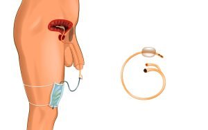Foley catheter and urinary tract infection