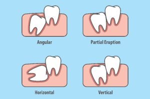 What is tooth impaction?