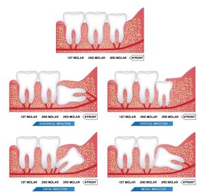 Set of impacted wisdom tooth and dental problems