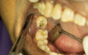 Horizontal impaction of lower right wisdom tooth