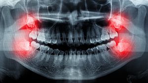 Film X-Ray scan human for tooth Impaction