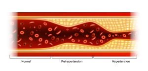 Different stages of hypertension