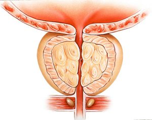 Prostate gland infection