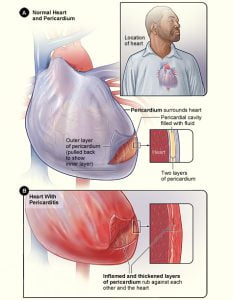 Basics of pericarditis