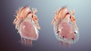 Pericarditis can progress to pericardial effusion and eventually