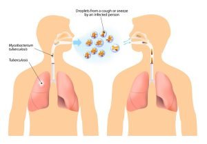 Tuberculous pericarditis