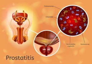 Inflammatory process in prostate gland