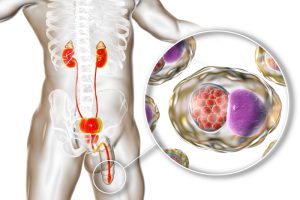 Chlamydiosis infection in man