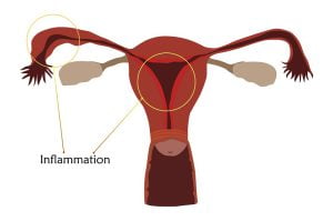 Pelvic inflammatory disease (PID) risk due to chlamydia