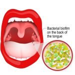 Halitosis (bad breath) causes