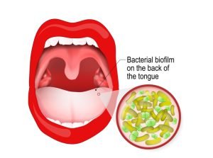 Halitosis (bad breath) causes