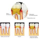 Bad breath and gum disease