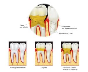 Bad breath and gum disease