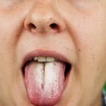 An illustration of a man with halitosis for candida albicans