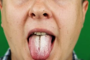 An illustration of a man with halitosis for candida albicans