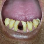Image of decaying teeth
