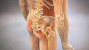 3D rendering of sciatica pinched nerve