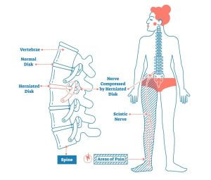 Sciatica basics