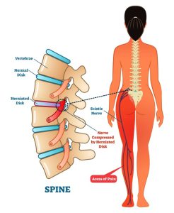 Sciatica in women