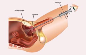cystoscopy procedure