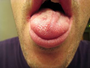 Dry mouth image