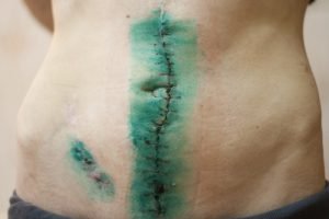 Scars after Crohn's surgery
