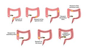 Research of the rectum