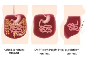 Colonoscopy for Crohn's disease