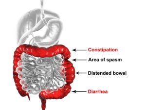 How does IBS affect your bowel?