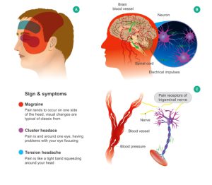 Migraine pain