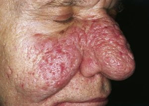 Rhinophyma: A Complication of Rosacea