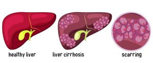 Scarring of liver