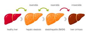 Stages of liver damage