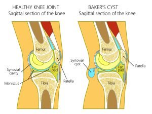 Illustration of a healthy human knee joint and unhealthy knee