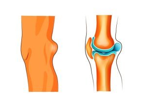 A Baker's cyst