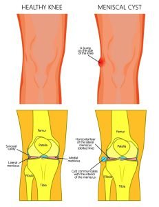 Illustration of a healthy human knee joint and unhealthy knee