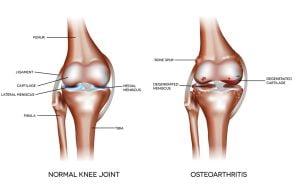 Bone cyst and arthritis