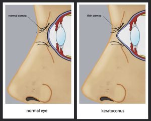 Image depicting what happens in keratoconus
