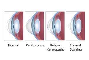 Common corneal conditions