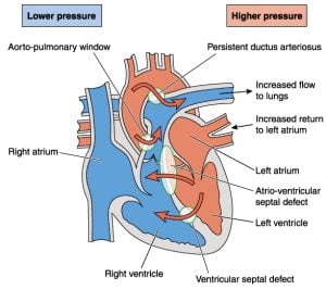 Congenital heart defects causing abnormal blood flow